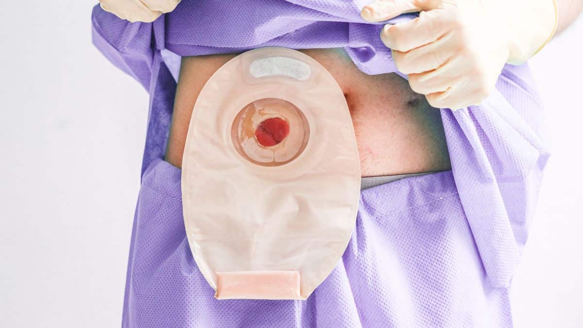 Passo a Passo para o Cuidado com Colostomia e Gastrostomia