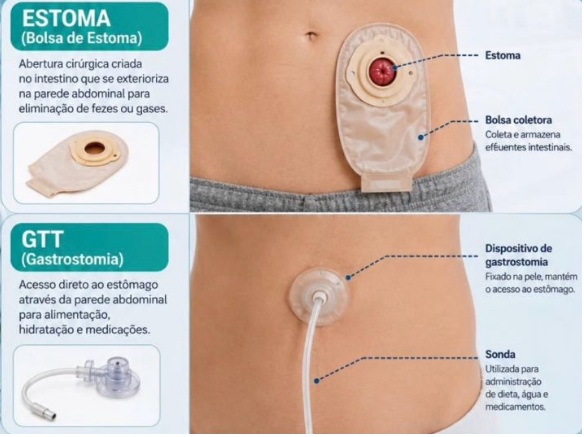 Qualificação do Cuidado: Manejo Seguro da Colostomia e da Gastrostomia